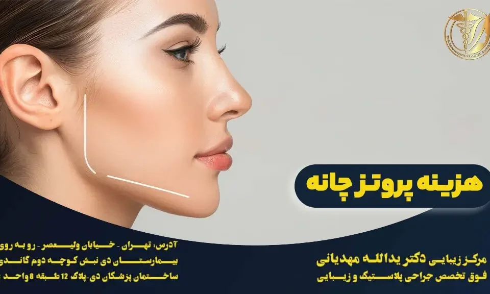 هزینه پروتز چانه