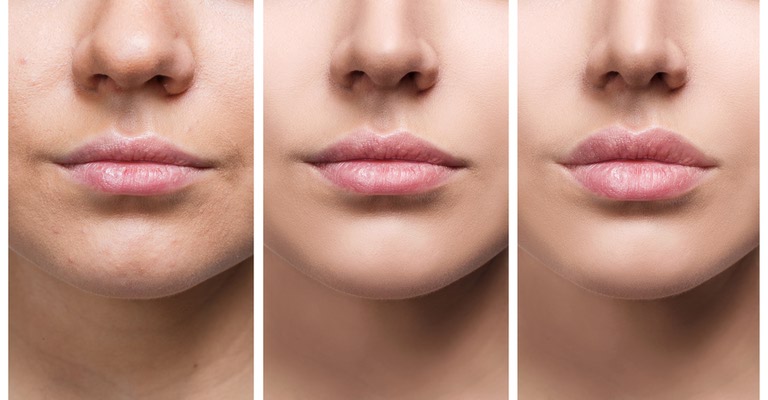 قبل و بعد از تزریق چربی به لب