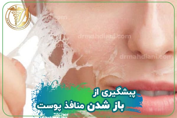 پیشگیری از باز شدن منافذ پوست