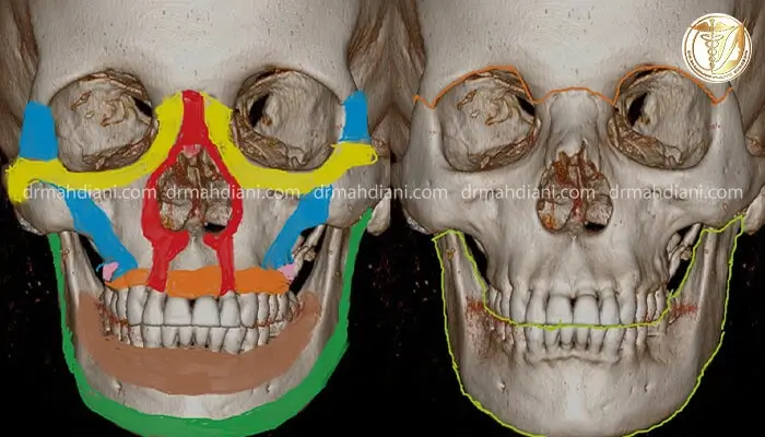 عکسی از استخوان صورت و انواع آسیب دیدگی صورت
