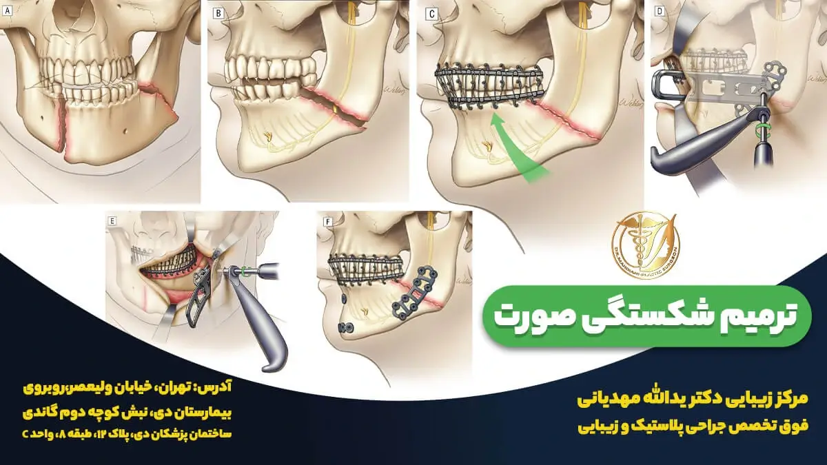 عکس شکستگی استخوان صورت و مراحل ترمیم شکستگی صورت